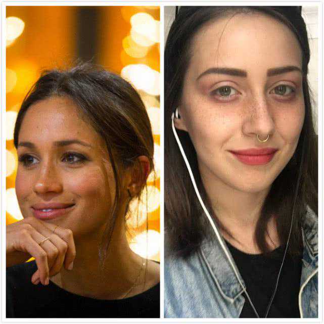 英女子痴迷梅根“雀斑妆”，拙劣手术让面部毁容，花3万治疗修复