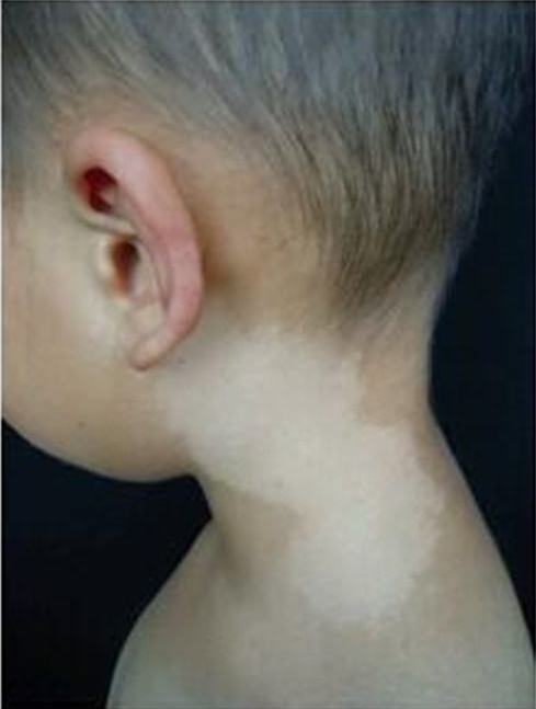 盘点7种常见的宝宝胎记，这2种不用管，剩下5种需要干预