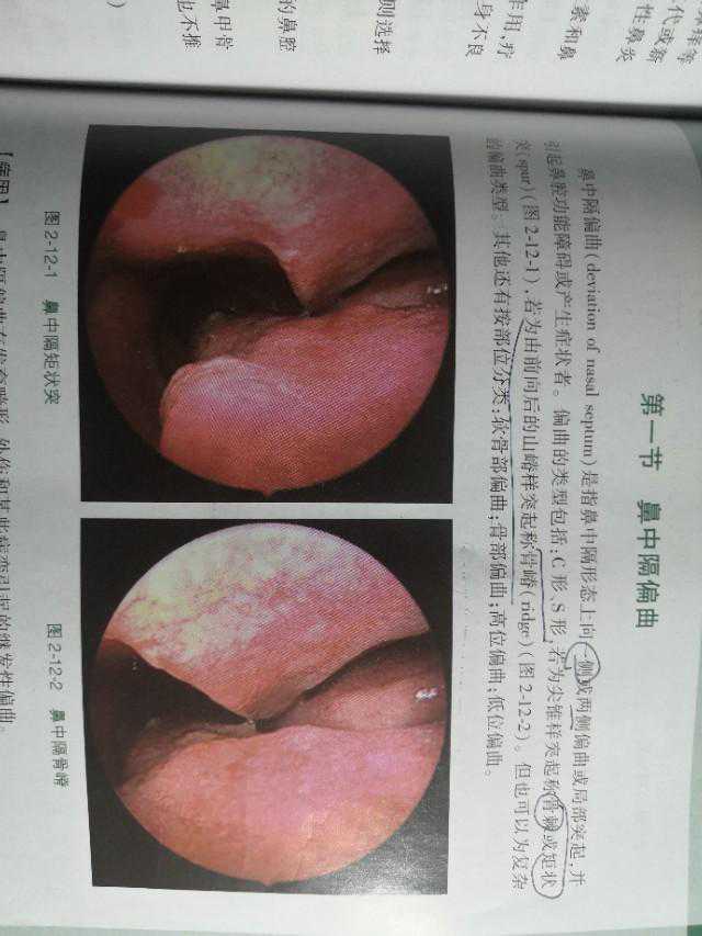 鼻中隔偏曲（小科普）