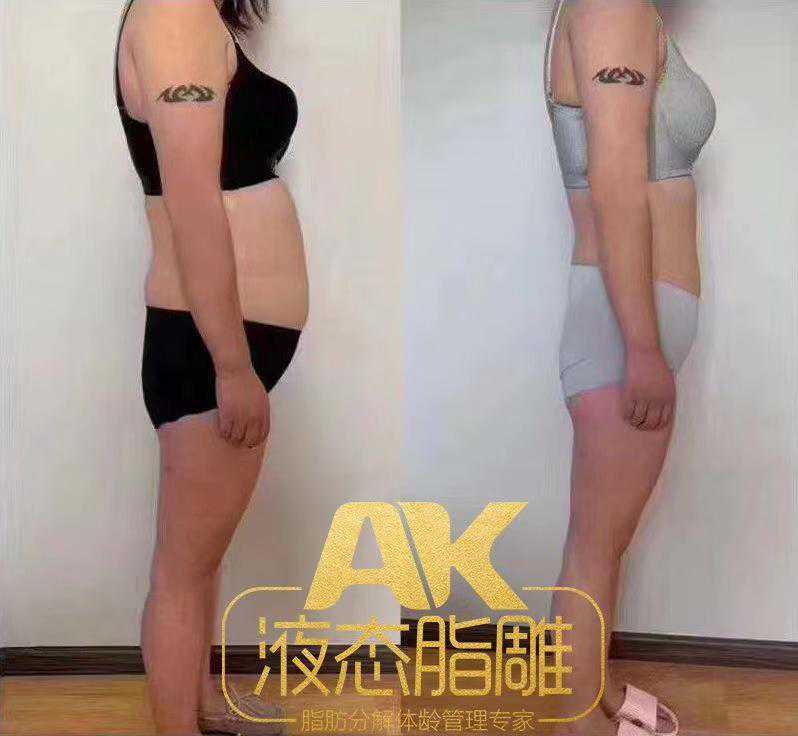 【AK—液态脂雕】 脂肪分解体龄管理专家