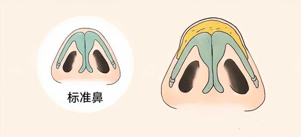 九院韦敏 | 鼻尖肥大如何改善？