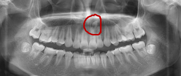 什么是多生牙？太可恶了（口腔科普第三十二期）