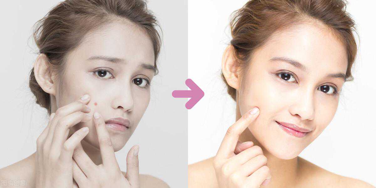 光子嫩肤对痘痘真的有效果么