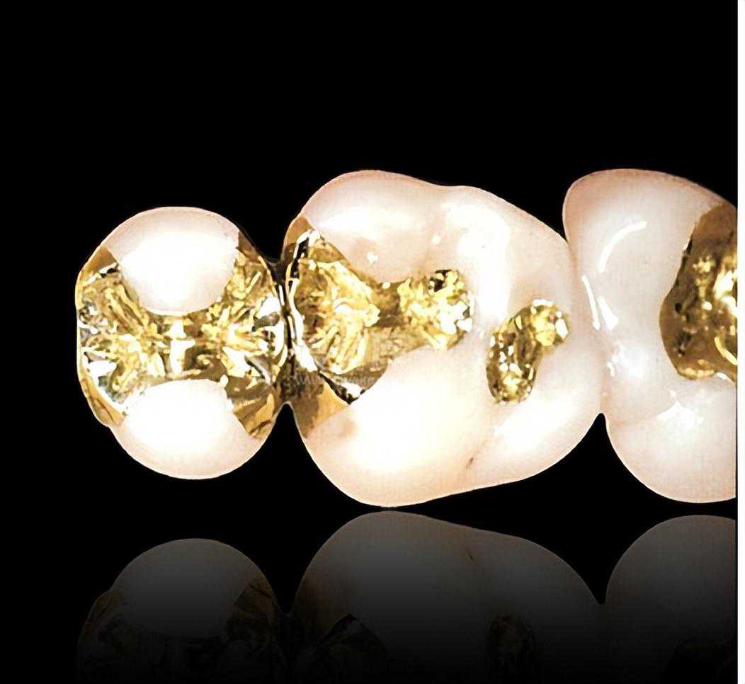 嵌体补牙是什么？