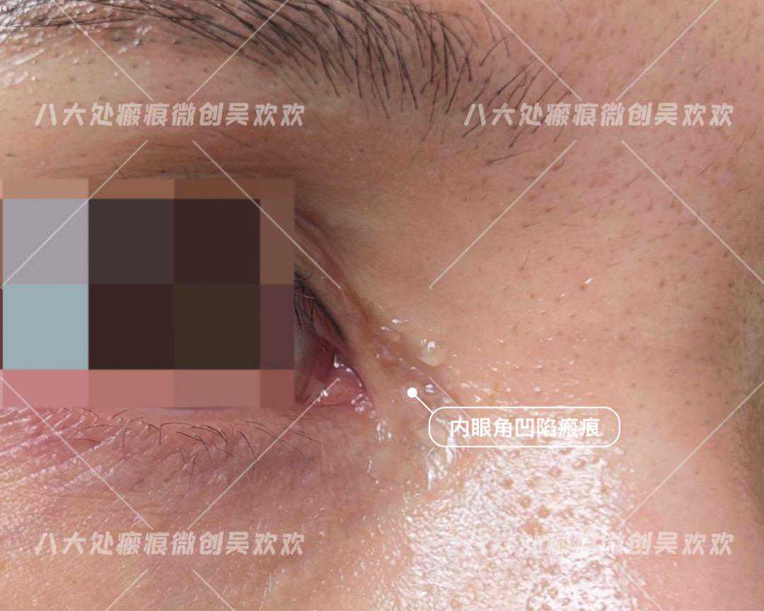 手术开内眼角，术后十年眼角瘢痕增生了