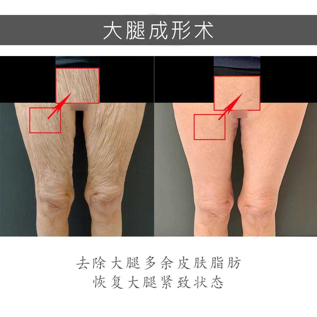 大腿脂肪多、皮肤松弛的人，应该了解的项目——大腿成形术