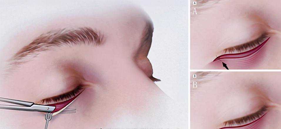 何为祛眼袋手术失败？