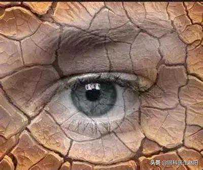 OPT脉冲光治疗是怎么治疗干眼的？值不值得做？