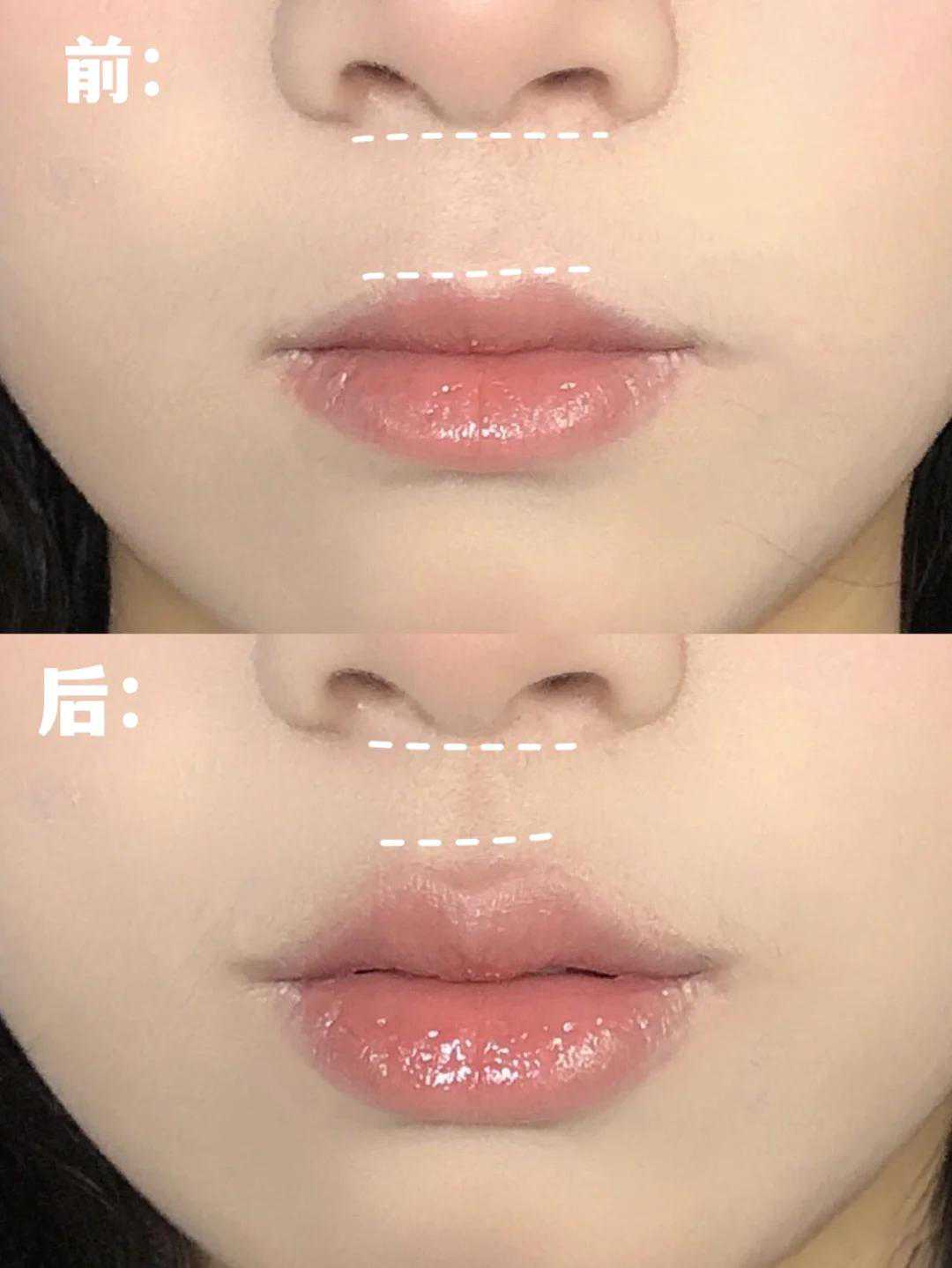 干货，改善凸嘴/长人中，人中缩短大法