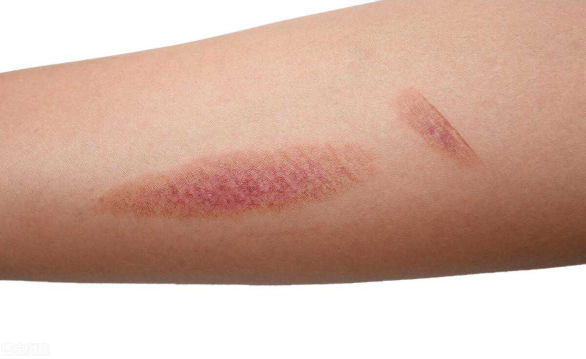 烫伤后如何快速祛除疤痕？