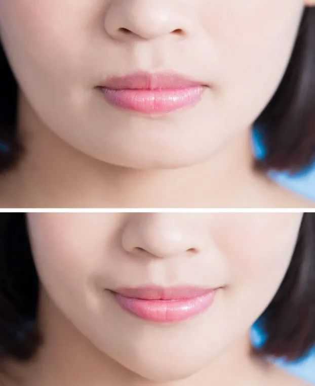 假体隆下巴是否需要取出更换