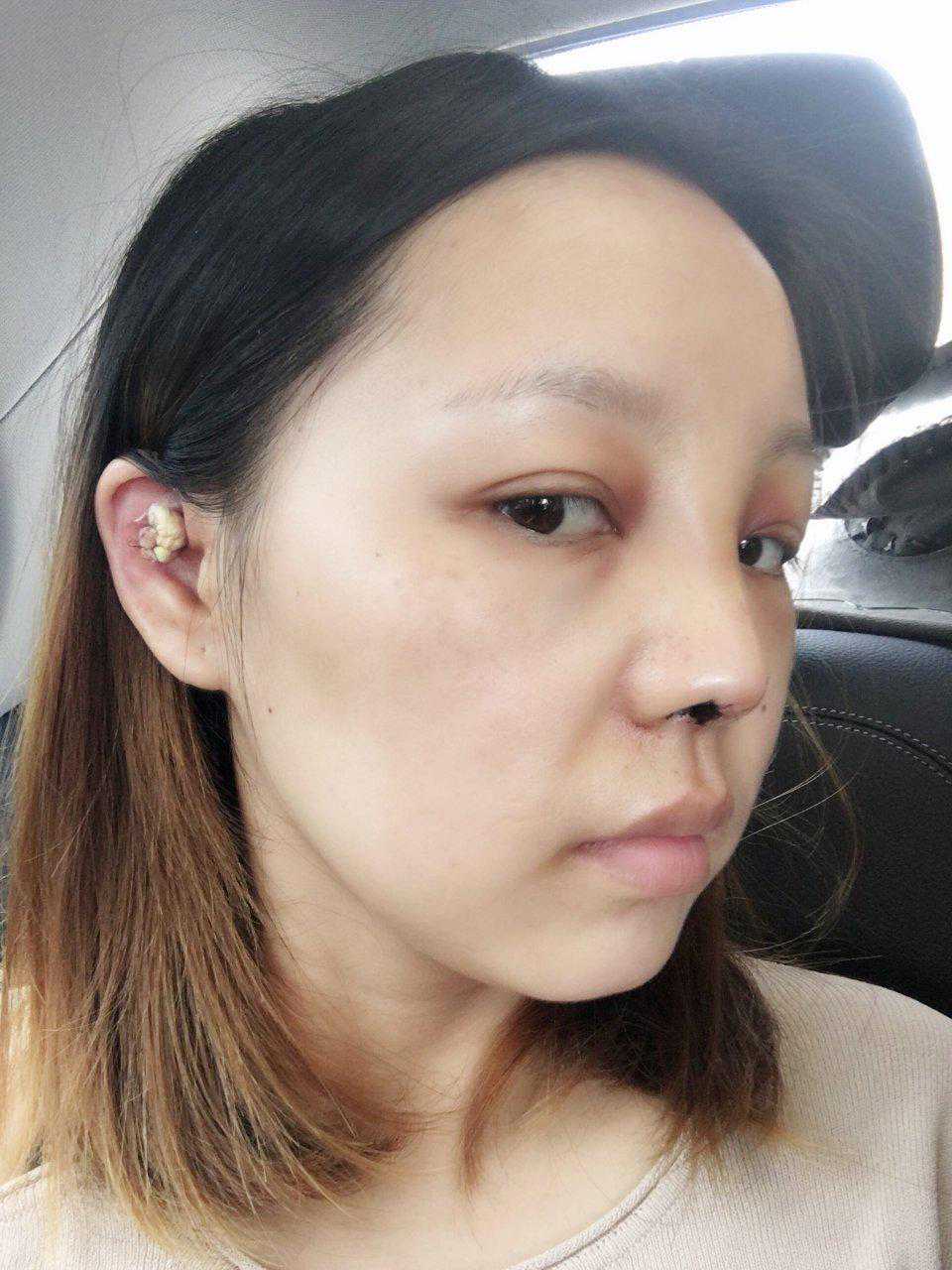 我做了一个成功的鼻综合