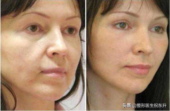 全脸自体脂肪填充，看着疼，效果真不错