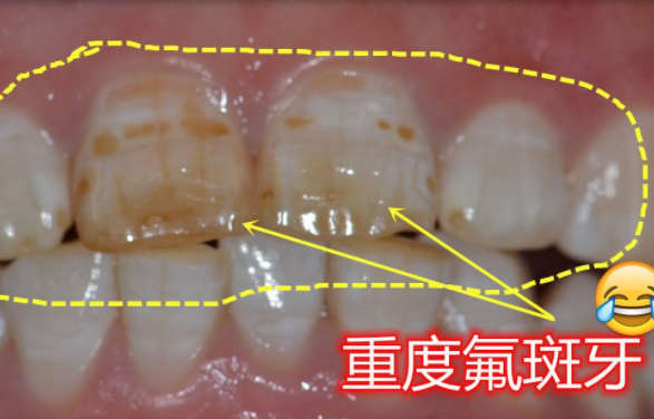氟斑牙治不好？老牙医：这几个方法可以改善