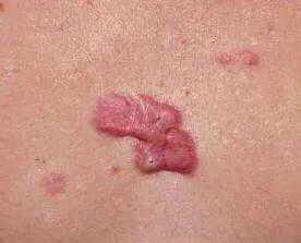 瘢痕体质的人能不能做美容手术？