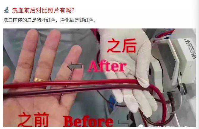 走红网络的“洗血”美容，怎么洗？有用吗！