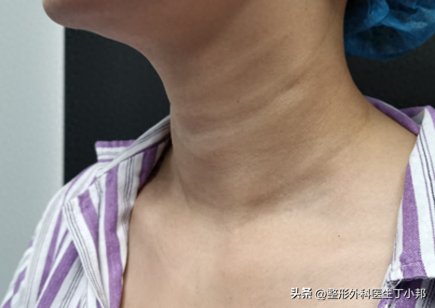 40岁女士打“假美容针”，颈纹填充失败，多条凸起来注射物取出