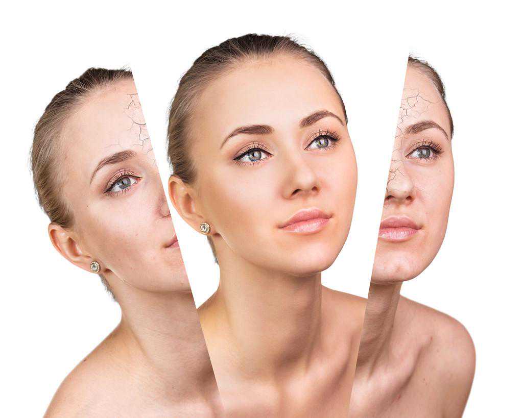 有没有快速祛斑，减少色素沉着中医美容方？一张小青龙汤推荐给您